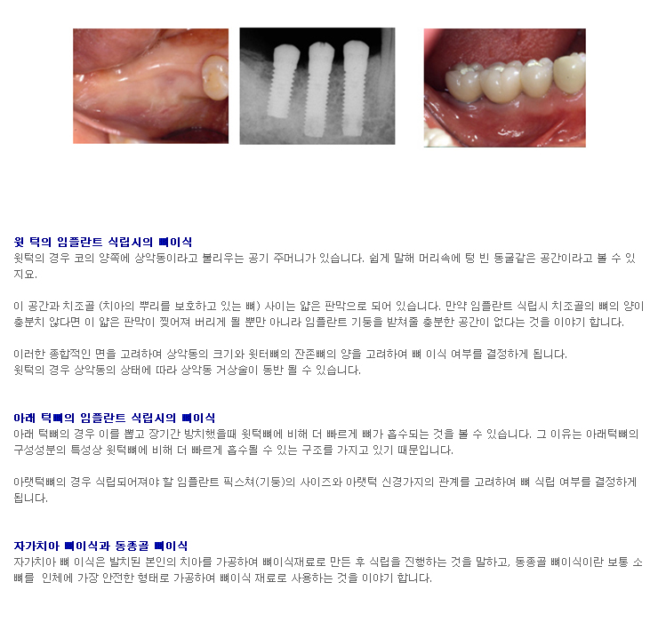 골소실로 인한 뼈이식.jpg