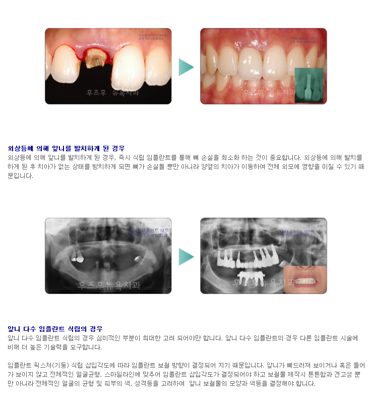 앞니 임플란트.jpg